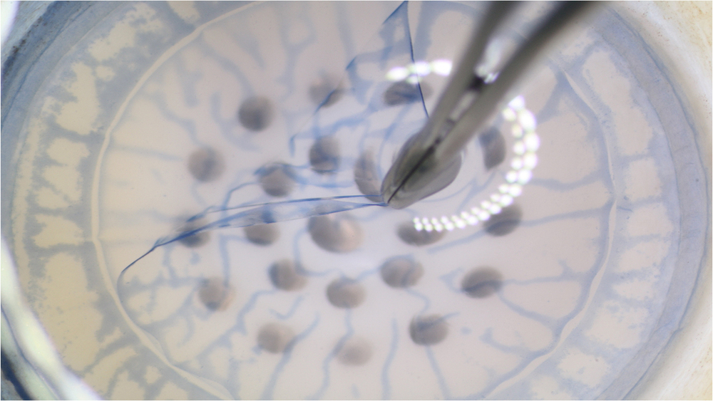 Hornhautlamelle - Präparation der Lamellären Hornhaut (LaMEK) unter dem Mikroskop in der Hornhautbank - Foto: DGFG